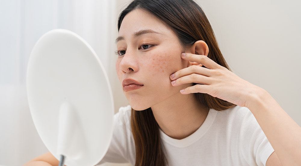 Mulher olhando no espelho seu melasma que será tratado na Clínica Nany Mota.